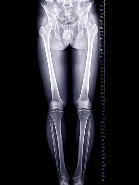 Scanogram Lower Limb Ray Image Total Lower Extremity Scale — Stock Photo, Image