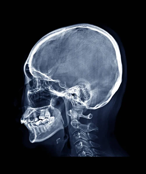 Рентгенівське Зображення Черепа Людини Бічний Вигляд Або Вид Збоку Ізольовані — стокове фото