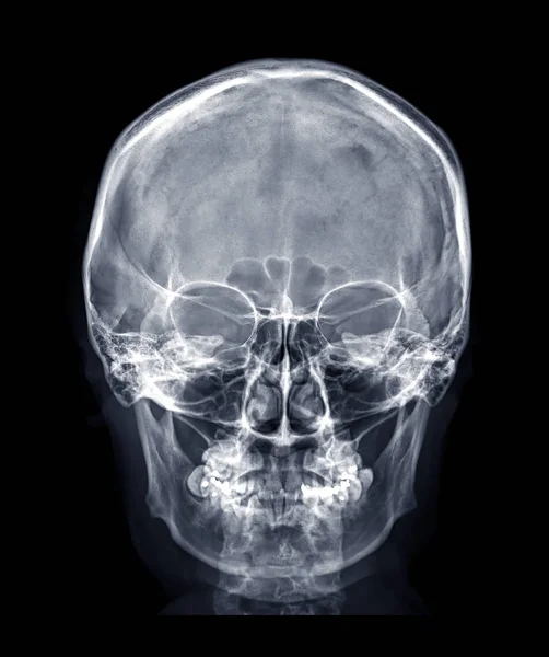 Skull Röntgen Bild Mänsklig Skalle Eller Främre Vyn Isolerad Svart — Stockfoto