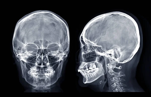 Рентгенівське Зображення Черепа Людини Lateral Ізольовано Чорному Тлі — стокове фото