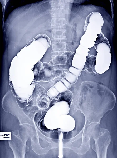 Imagen Enema Bario Vista Que Muestra Colon Recto Bajo Control — Foto de Stock