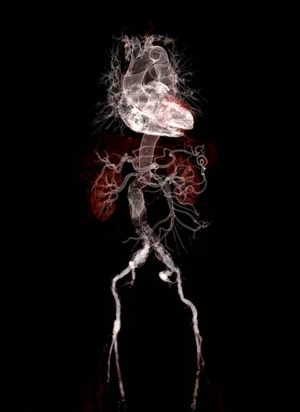 Cta Abdominale Aorta Rendering Bild Mit Stententransplantat Auf Transparentem Skelett — Stockfoto