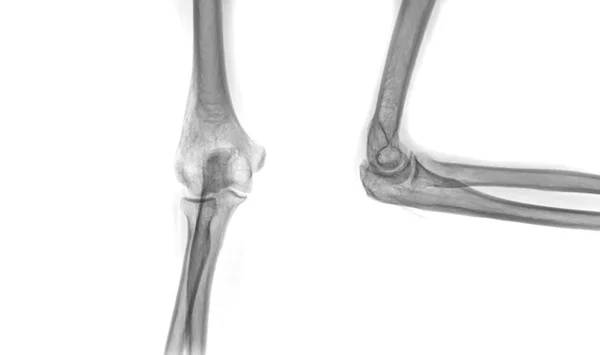 Gomito Raggi Radiografia Del Gomito Destro Vista Laterale Frattura Diagnostica — Foto Stock