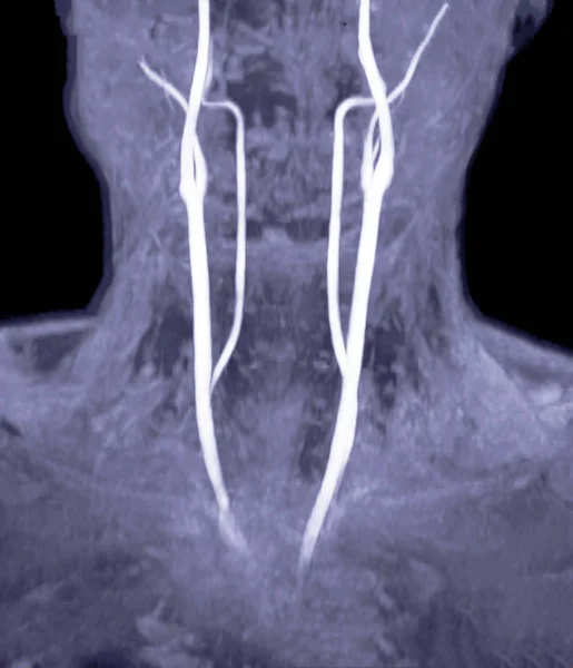 Angiografia Cérebro Ressonância Magnética Artéria Carótida Comum Cérebro — Fotografia de Stock