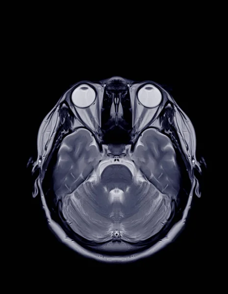 Mri Plano Axial Cérebro Para Detectar Uma Variedade Condições Cérebro — Fotografia de Stock