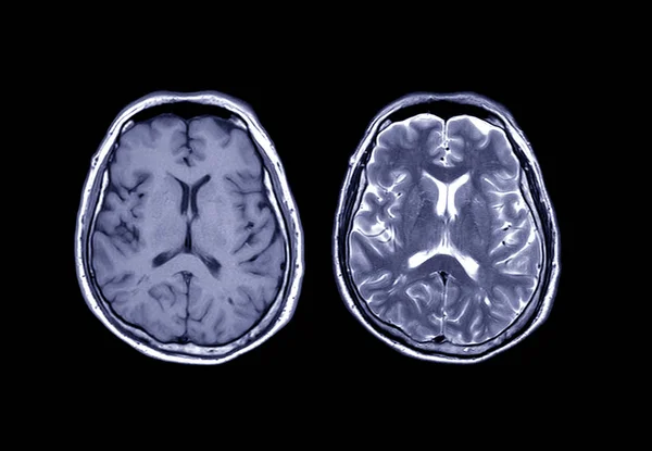 Összehasonlítás Mri Agy Axial Kimutatására Különböző Körülmények Között Agy Mint — Stock Fotó