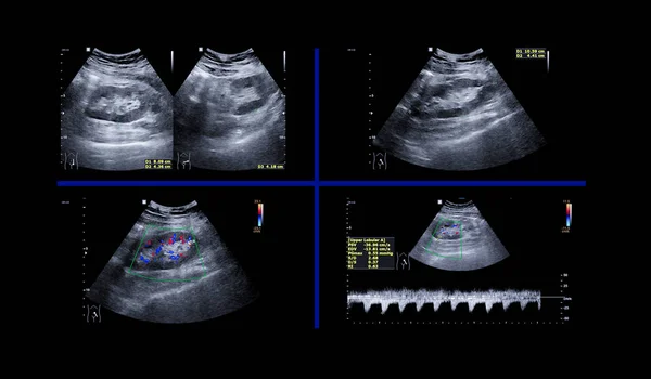 Ultrassom Abdômen Superior Rim Ultra Som Mostrando Função Renal — Fotografia de Stock