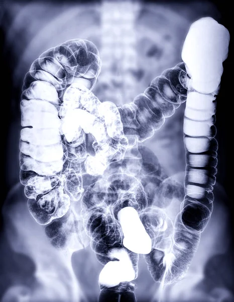 钡灌肠或Be的选择性聚焦是在氟控制下 在结肠注射钡造影剂后大肠的影像 — 图库照片