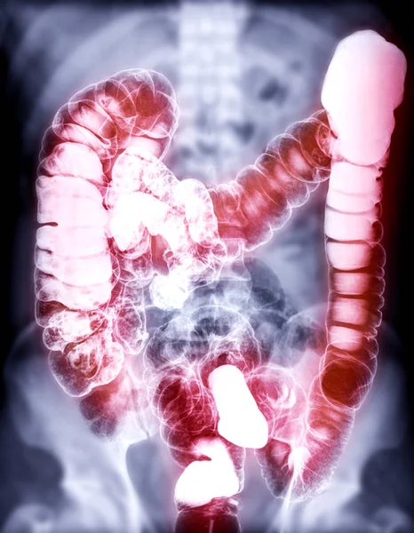 Enema Bario Una Imagen Intestino Grueso Después Inyección Contraste Bario — Foto de Stock