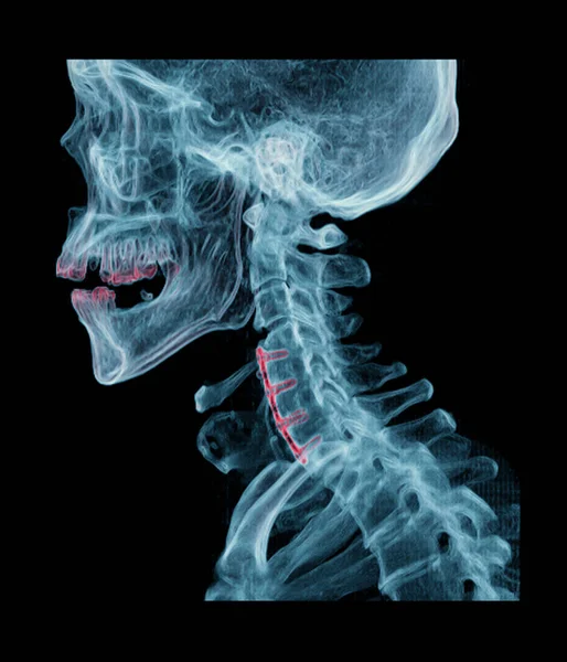 Vergleich Der Wirbelsäule Oder Halswirbelsäule Darstellung Axiale Laterale Und Koronale — Stockfoto