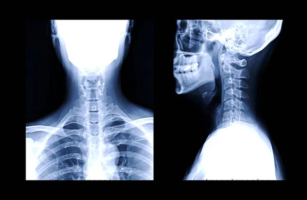 颈椎Ap和侧视的X线C线或X线影像诊断椎间盘突出症 — 图库照片