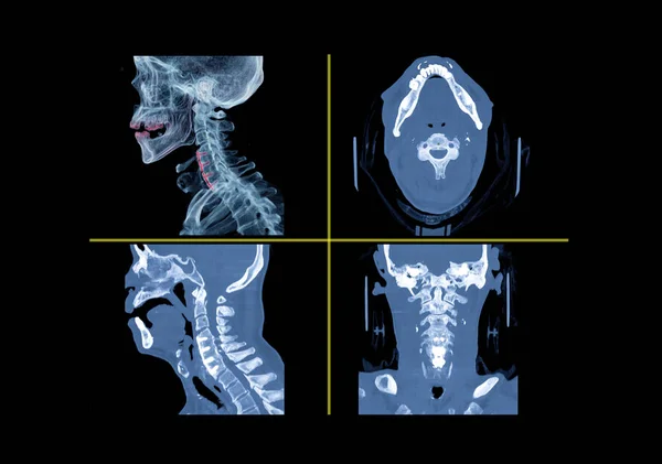 Σύγκριση Spine Αυχενική Σπονδυλική Στήλη Εικόνα Αποτύπωσης Αξονική Πλευρική Και — Φωτογραφία Αρχείου