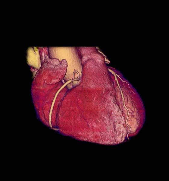Cta Imagem Renderização Artéria Coronária Para Encontrar Doença Arterial Coronariana — Fotografia de Stock