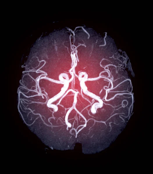 脳内の船舶のMra Brainまたは磁気共鳴血管造影 Mri それらの狭窄 動脈瘤を評価するための軸方向のミップビュー — ストック写真