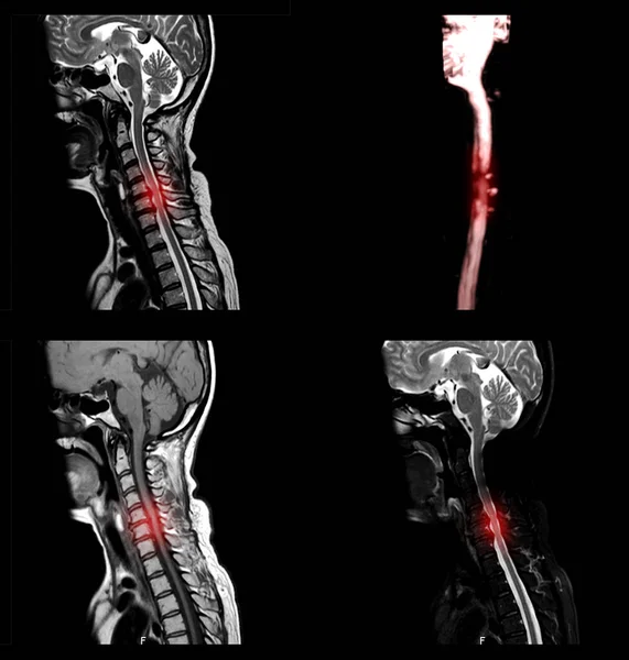 Widok Kręgosłupa Szyjnego Lub Rezonans Magnetyczny Kręgosłupa Szyjnego Wykazujący Spondylozę — Zdjęcie stockowe