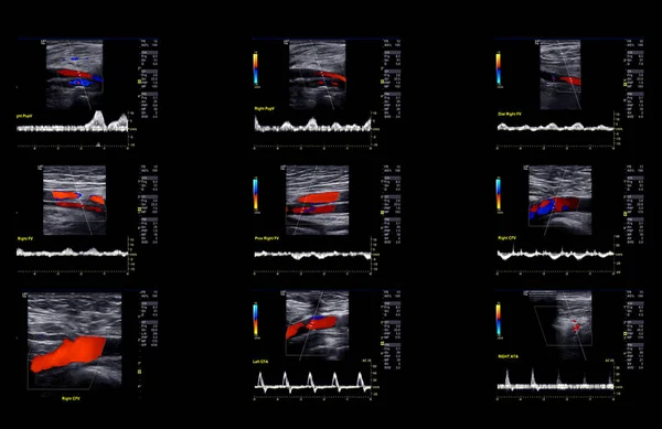 Ultrasonido Doppler Para Encontrar Trombosis Venosa Profunda Extremidad Inferior —  Fotos de Stock