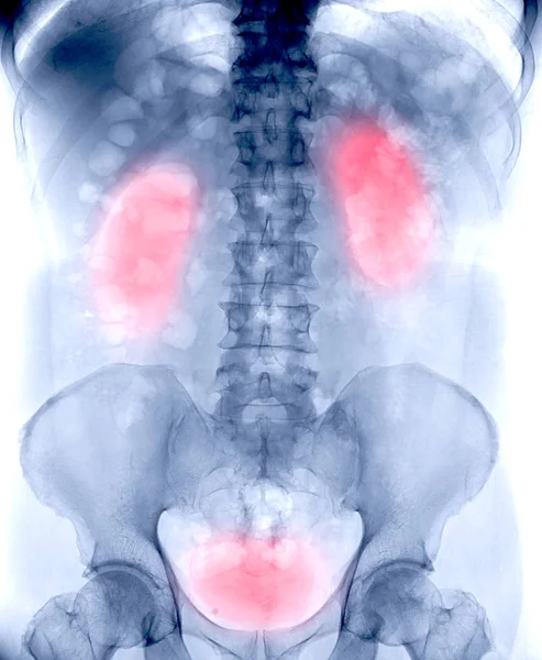 Plain Kub Ray Image Urinary System Showing Kidney Bladder Organ — Stock Photo, Image