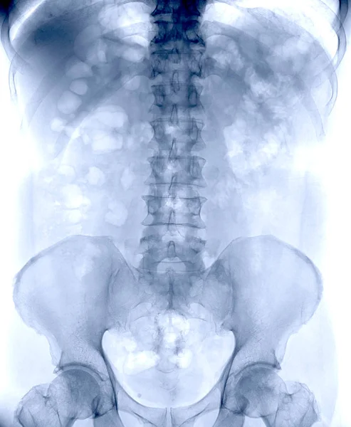 일반적 Kub 사람의 복부에 해부학적 Ray 이미지입니다 — 스톡 사진