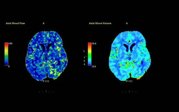 Перфузійне Сканування Мозку Червоний Зелений Синій Області Затримки Кровотоку Мозку — стокове фото