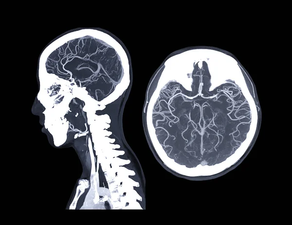 Cta Hersenen Angiografie Van Hersenen Sagittale Axiale Mip View Concept — Stockfoto