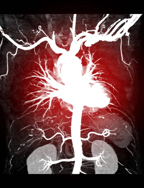 CTA thoracic aorta 3D MIP image with injection contrast media into thoracic aorta.