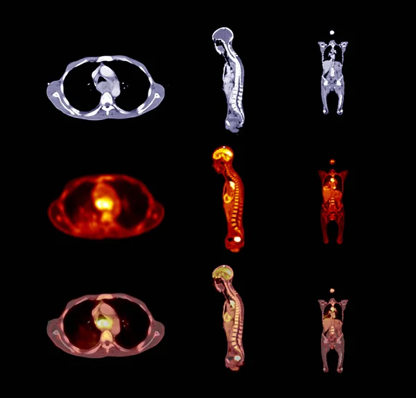全身比較のペットCtスキャン画像患者のがん疾患の再発を検出するための軸 射手座および平面 — ストック写真