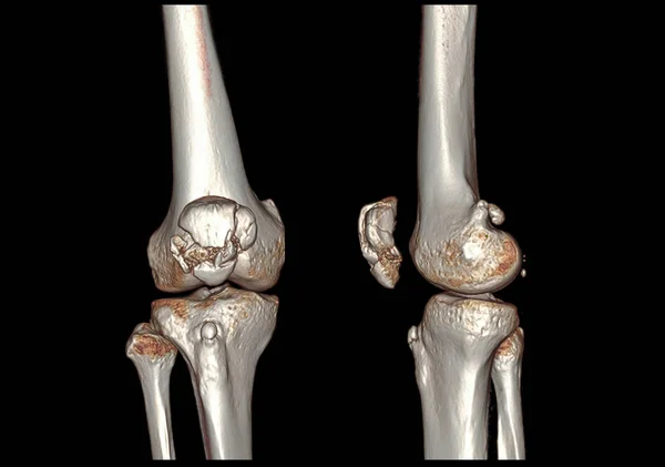 Ct膝关节3D渲染图像Ap和侧视隔离在黑色背景上显示骨折肩胛骨 — 图库照片