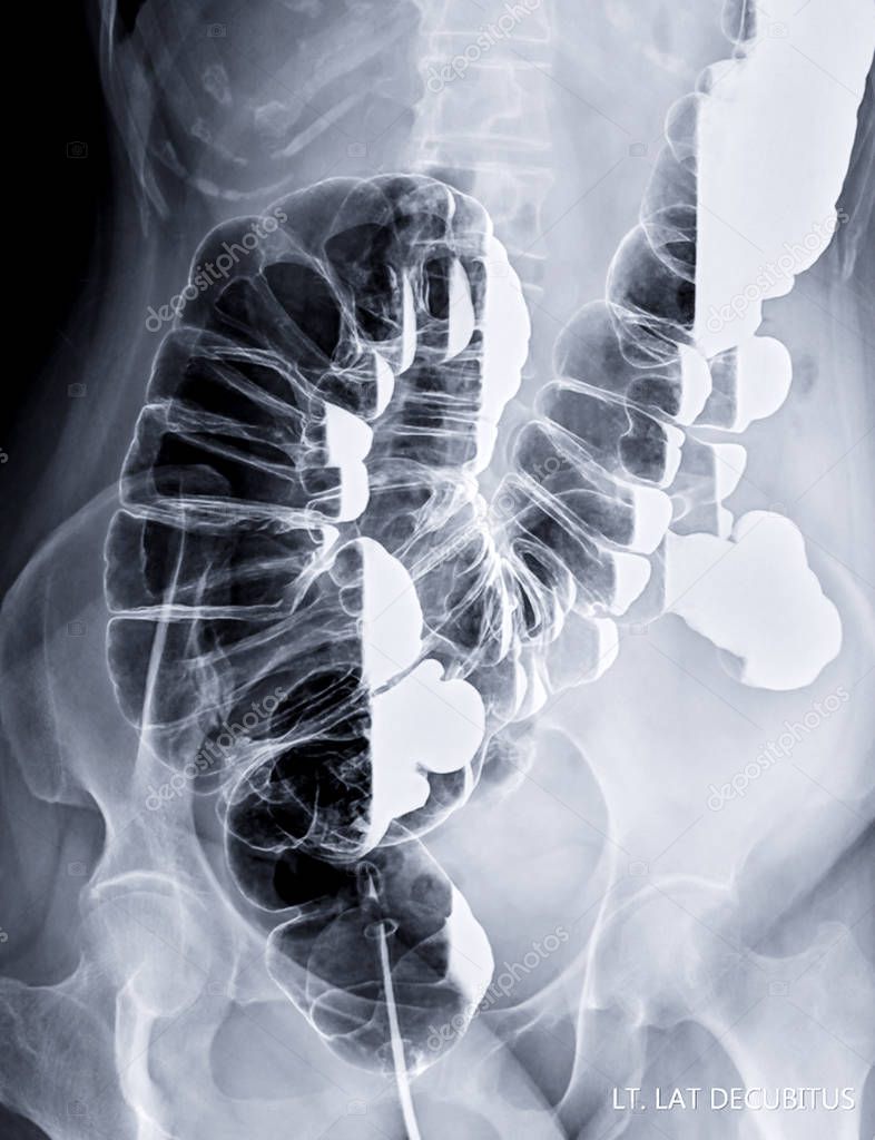 barium enema image