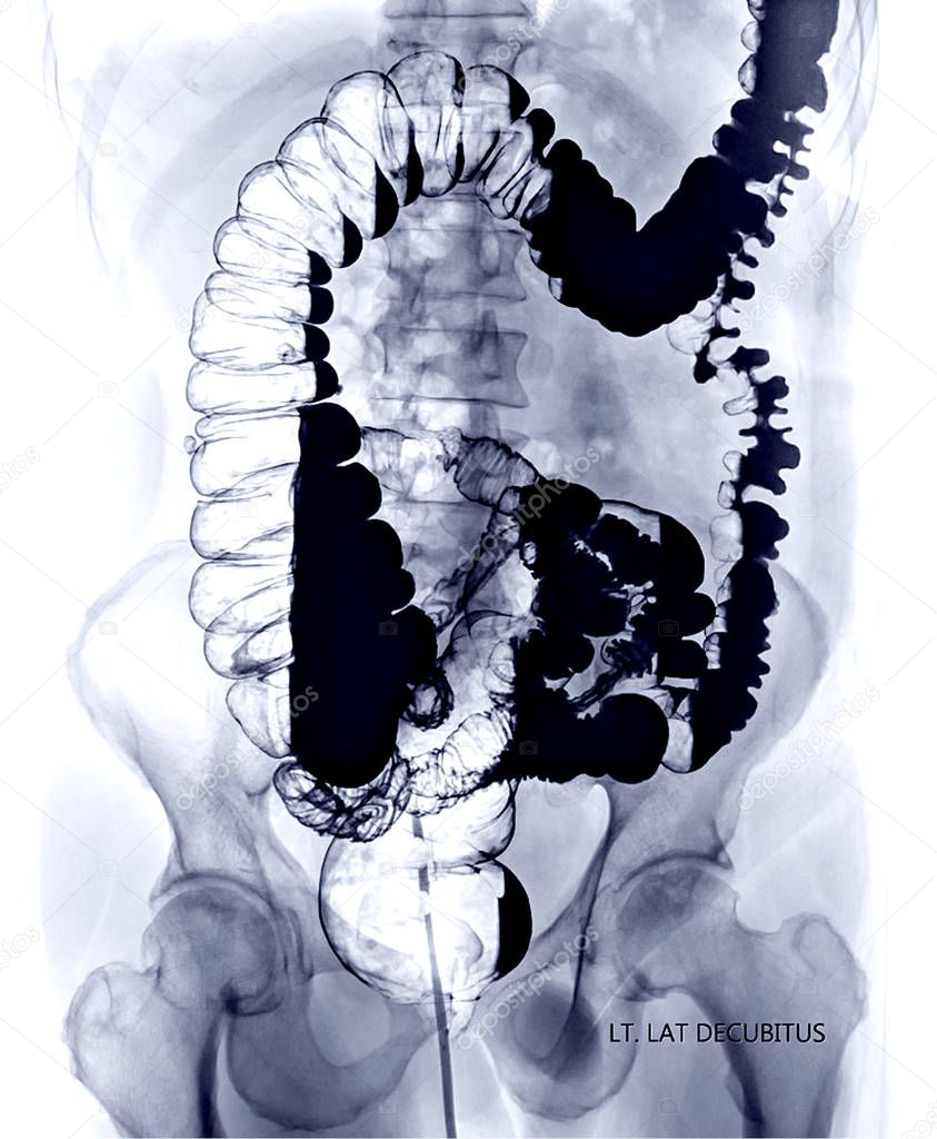 barium enema image or BE LEFT lateral decubitus view  showing air and barium sulfate fill in colon or large intestine.  