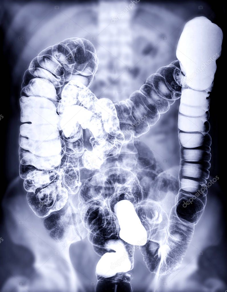 Selective focus of Barium enema or BE is image of large bowel after injection of barium contrast fill into colon under fluoroscopic control.