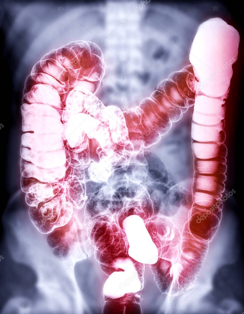 Barium enema or BE is image of large bowel after injection of barium contrast fill into colon under fluoroscopic control.