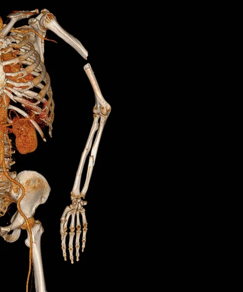 Ct扫描3D左肩和左臂骨折的影像学表现 — 图库照片