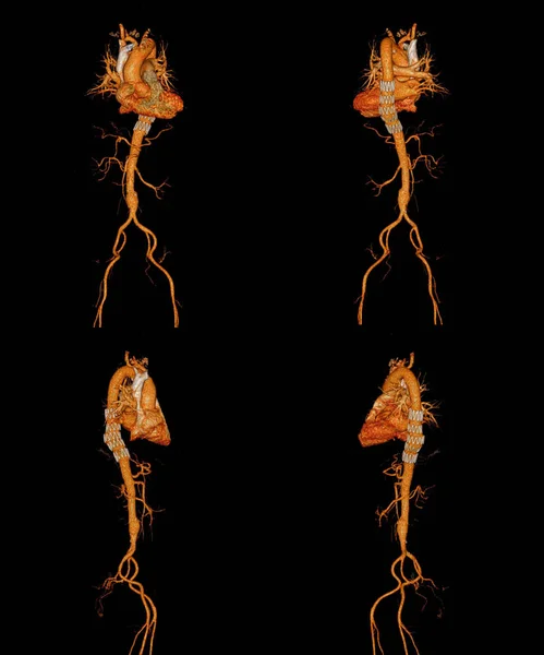 Cta Celá Aorta Vykreslování Obraz Stent Štěpu — Stock fotografie