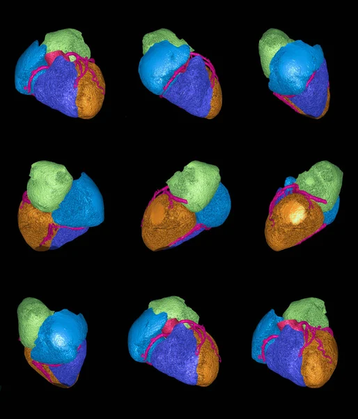 Cta Imagem Renderização Artéria Coronária Para Diagnóstico Doença Vaso Cardíaco — Fotografia de Stock