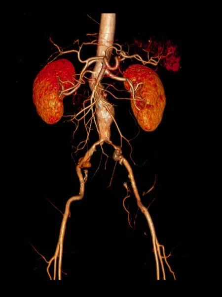 Abdomilan Aorta Rendering Zur Diagnose Von Aortenaneurysma Und Demostrater Niere — Stockfoto