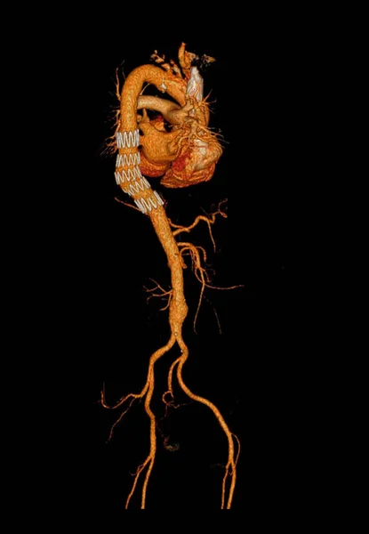 Cta Hela Aorta Rendering Bild Med Stent Transplantat — Stockfoto