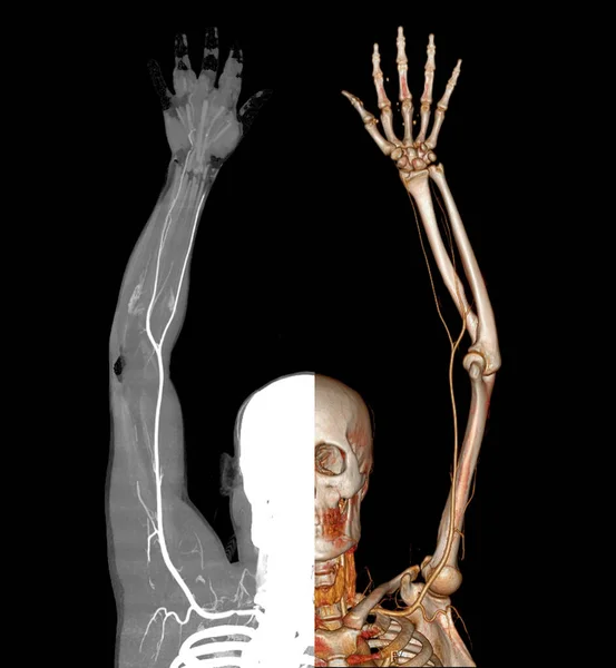 Jämförelse Datortomografi Rendering Med Kontrastmediainjektion Till Kärl — Stockfoto