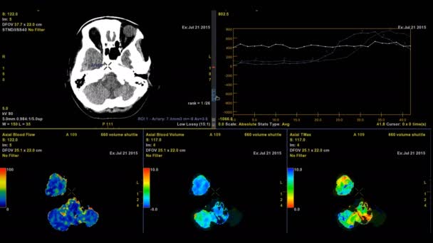 Séquence Perfusion Cérébrale Isolée Sur Noir — Video