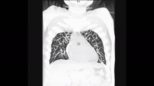 Beelden Van Mri Van Longen Geïsoleerd Zwart — Stockvideo