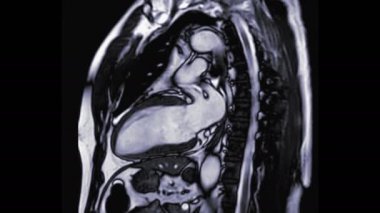 footage of heart MRI RVOT View isolated on black