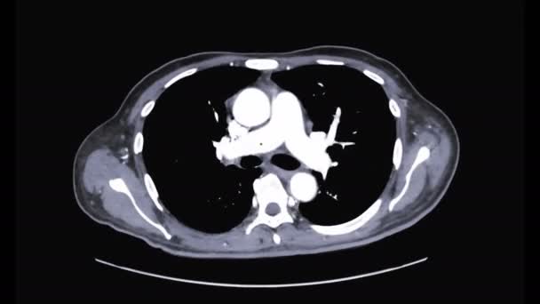 Footage Cta Upper Axial Bones Isolated Black — Stock Video