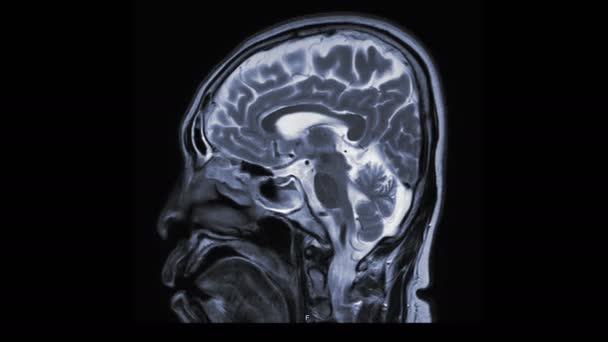 Imágenes Resonancia Magnética Del Cerebro Aislado Negro — Vídeo de stock