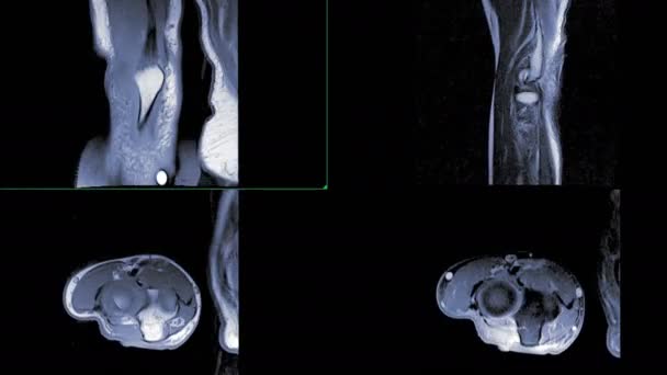 Πλάνα Του Mri Του Αγκώνα Απομονώνονται Μαύρο — Αρχείο Βίντεο