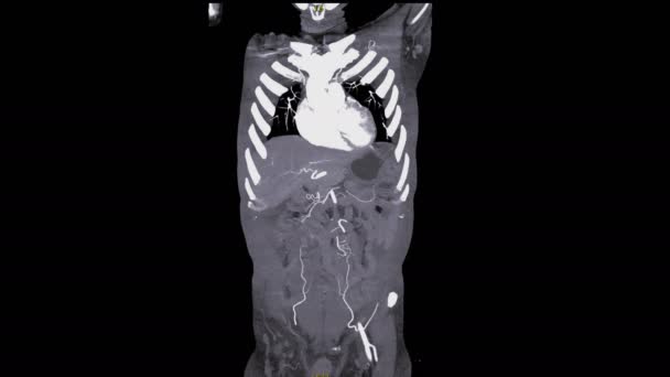 Footage Cta Aorta Isolated Black — Stockvideo