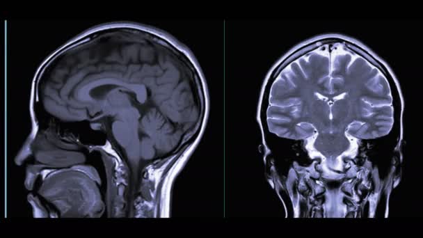 Aufnahmen Von Mri Des Gehirns Isoliert Auf Schwarz — Stockvideo