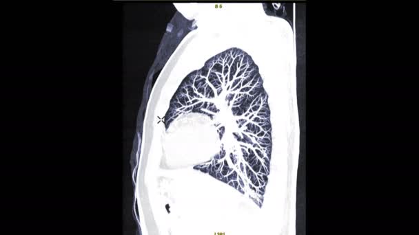 Footage Mri Lung Isolated Black — Stock Video