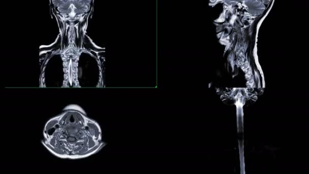 Imágenes Resonancia Magnética Columna Vertebral Aislada Negro — Vídeo de stock