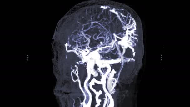 Πλάνα Από Cta Brain Απομονωμένο Μαύρο — Αρχείο Βίντεο