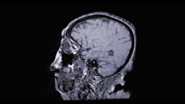 Imágenes Resonancia Magnética Del Cerebro Aislado Negro — Vídeo de stock