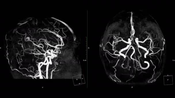 Footage Mri Brain Artery Isolated Black — Stock Video